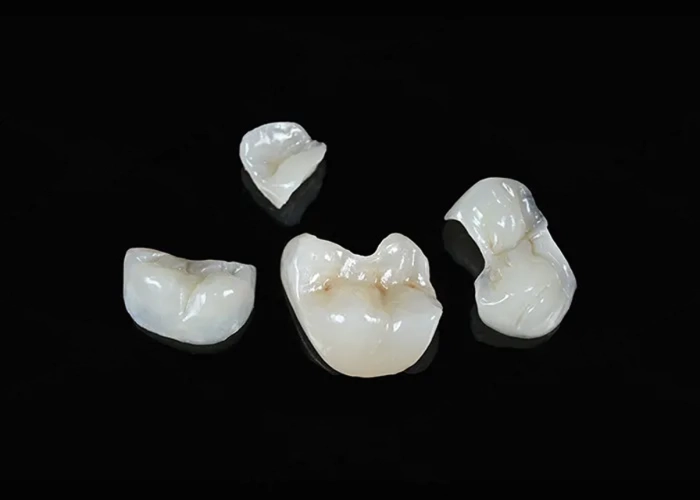 Inlay/Onlay Adoro Composite 1