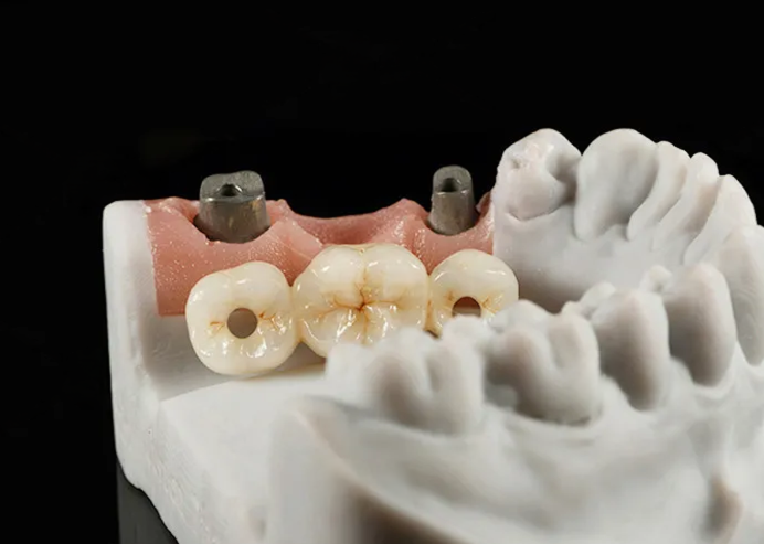 Pilier titane transvissé 3