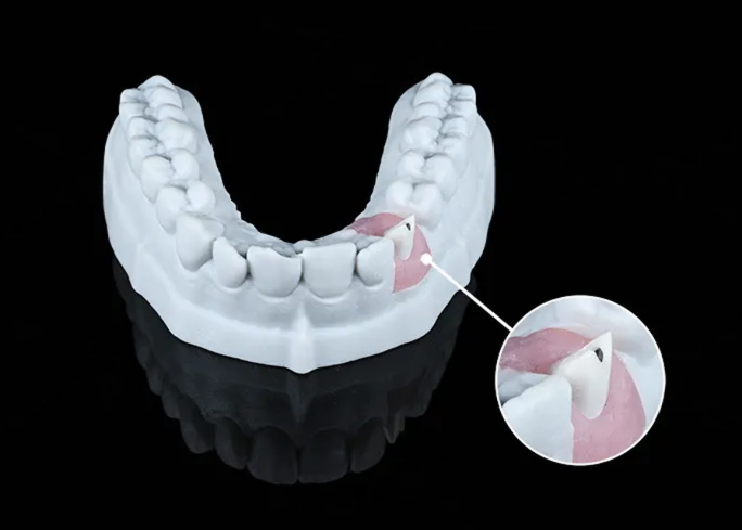 Pilier zircone 4